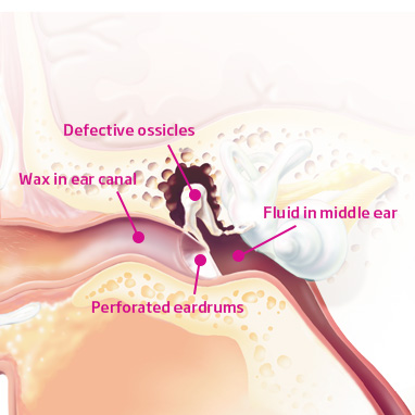 Ear canal with ear drum